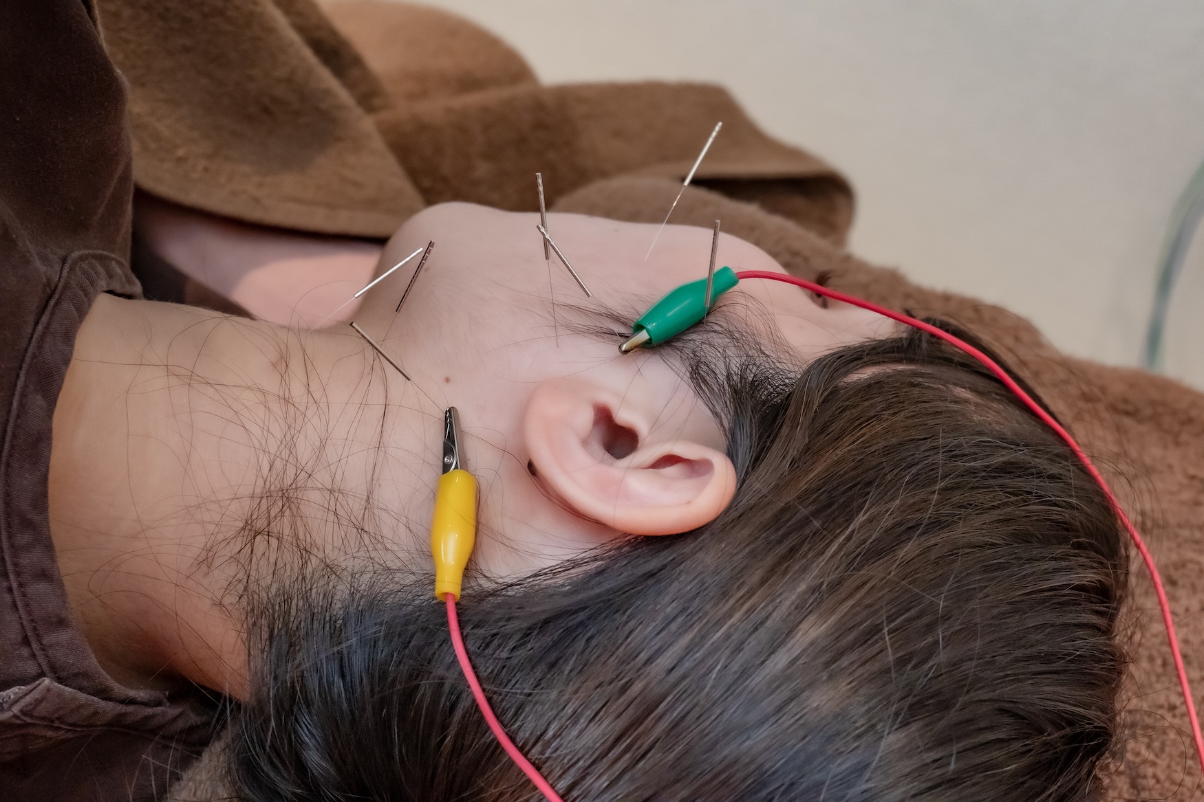 立ち上がると耳が「ぽこっ」とする症状と鍼灸