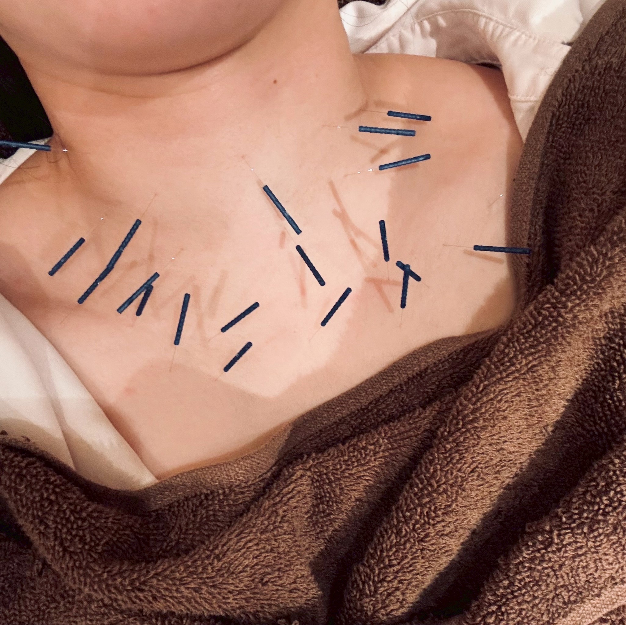 ヒステリー球と鍼灸 〜のどの詰まり感〜