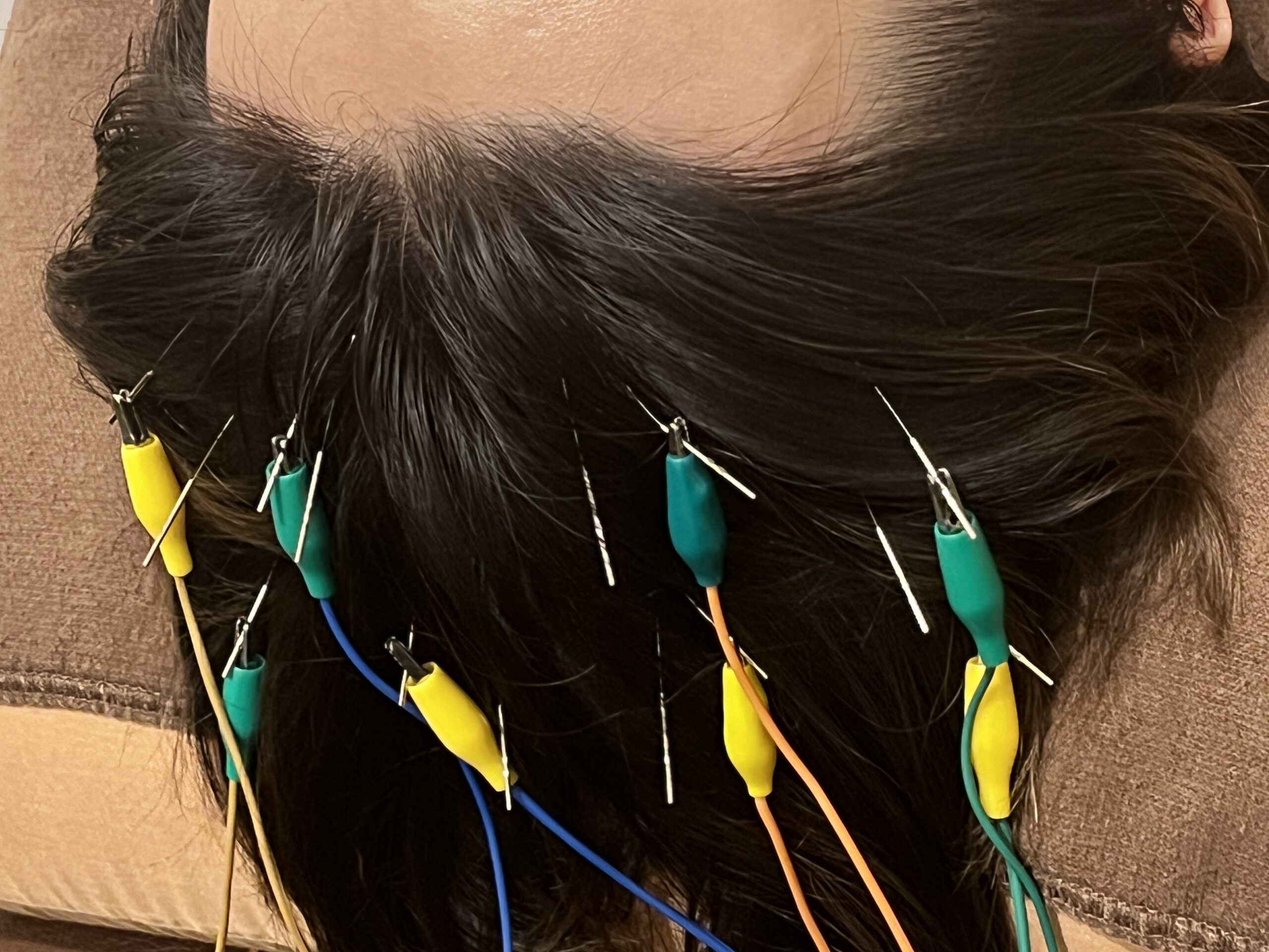 脳疲労と鍼灸 〜頭を休ませる時間を〜