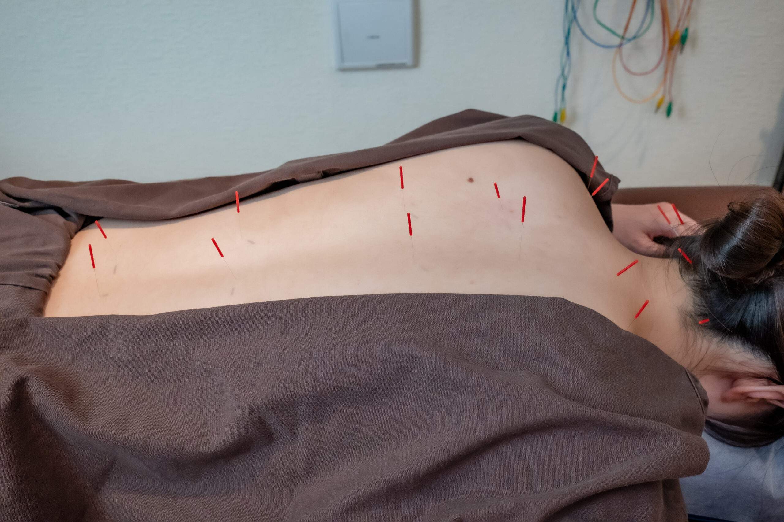 鍵盤炎でつらい手首を鍼灸で軽くする方法