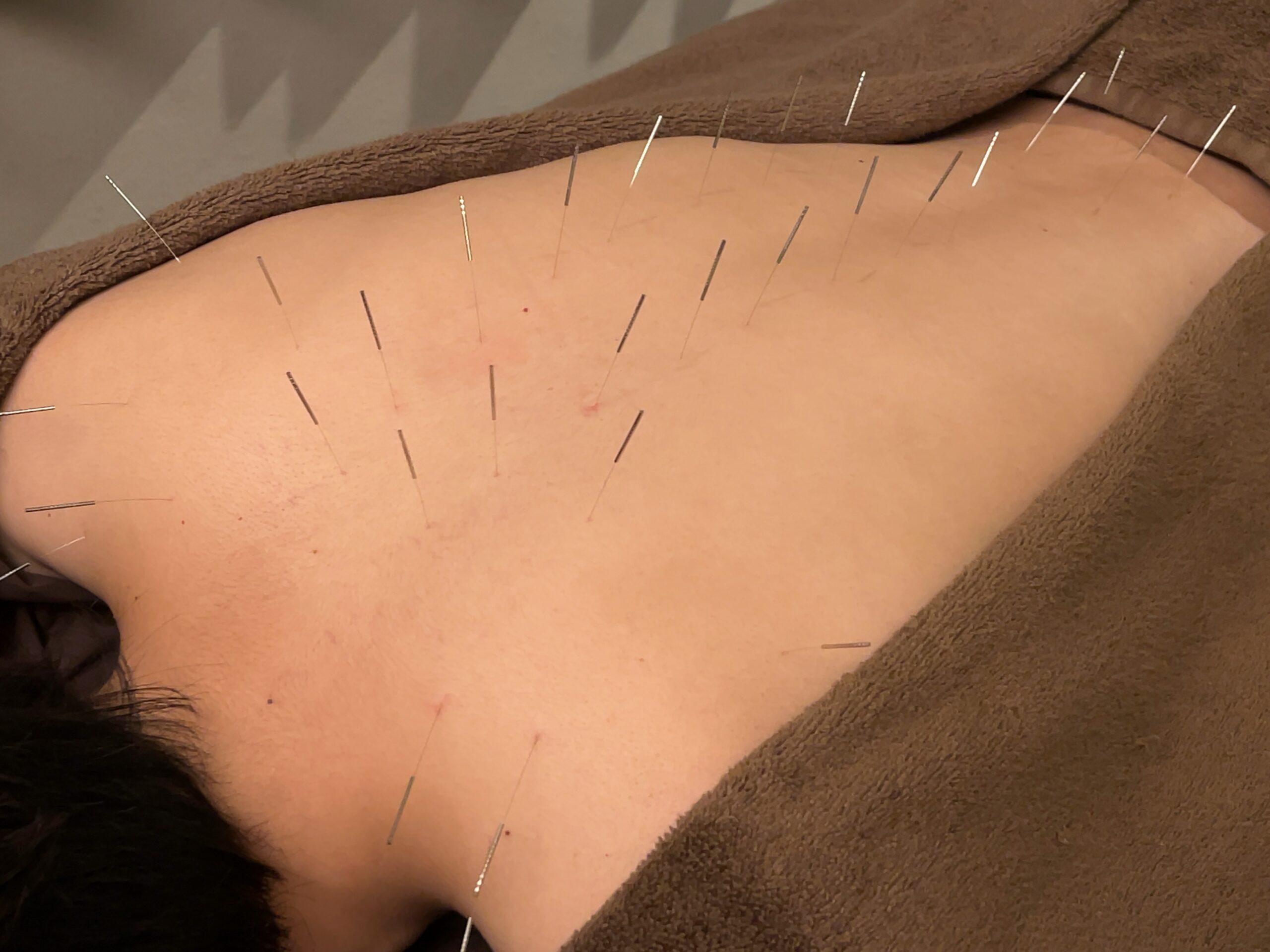 マッサージでは戻るのに、なぜ鍼だと変わるのか